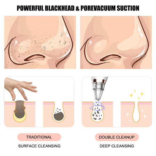 New electric blackhead removal and pore cleaning for blackheads