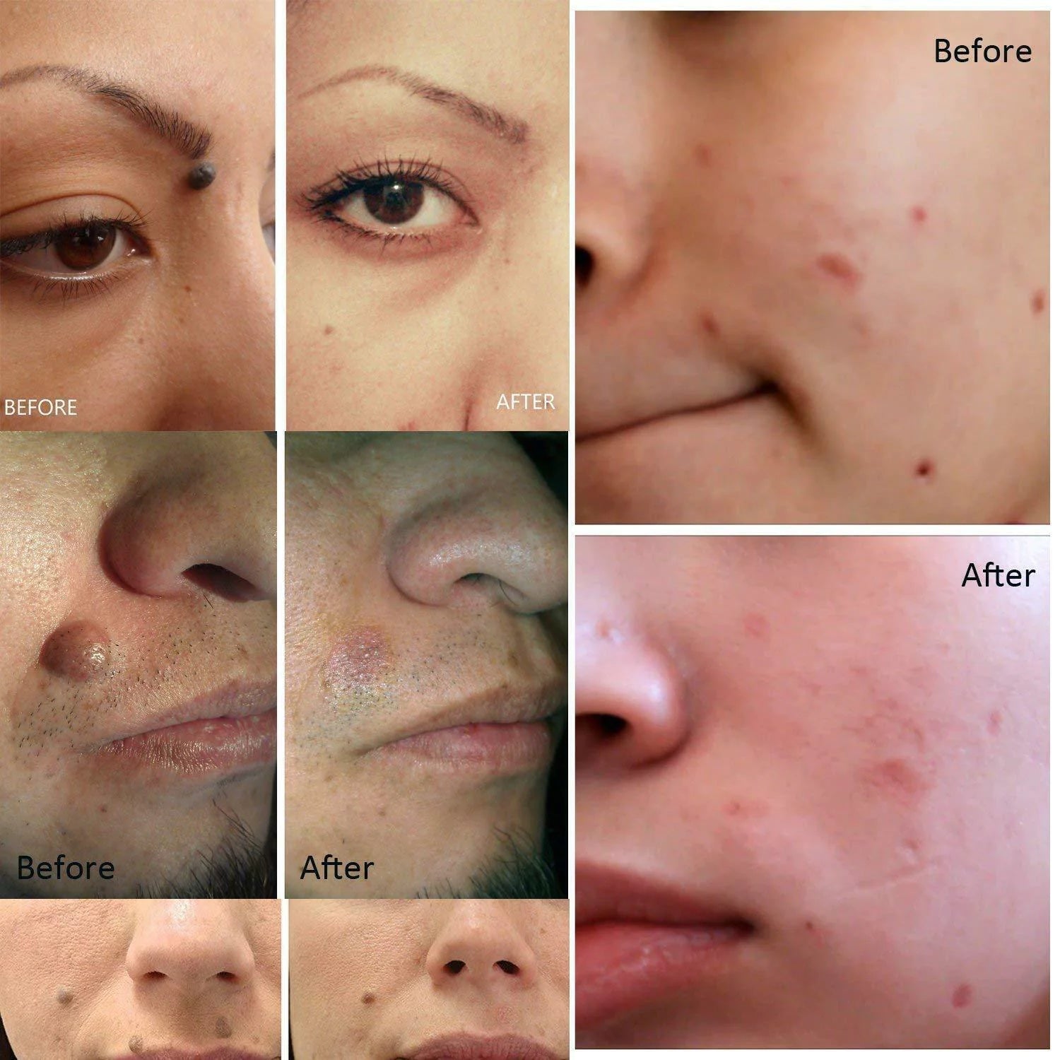 SkinPro Spot & Mole Eraser